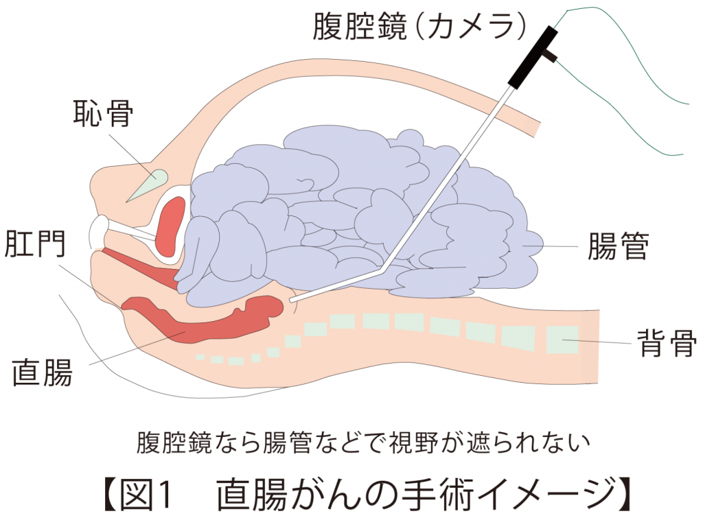 直腸がんの手術イメージ